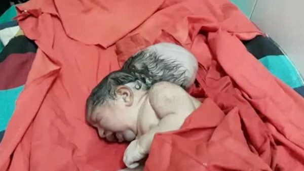 Bebê nasce com três cabeças e pai tenta enterrar criança viva